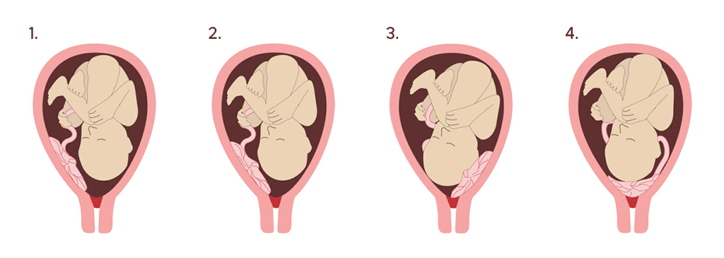 placenta posities 